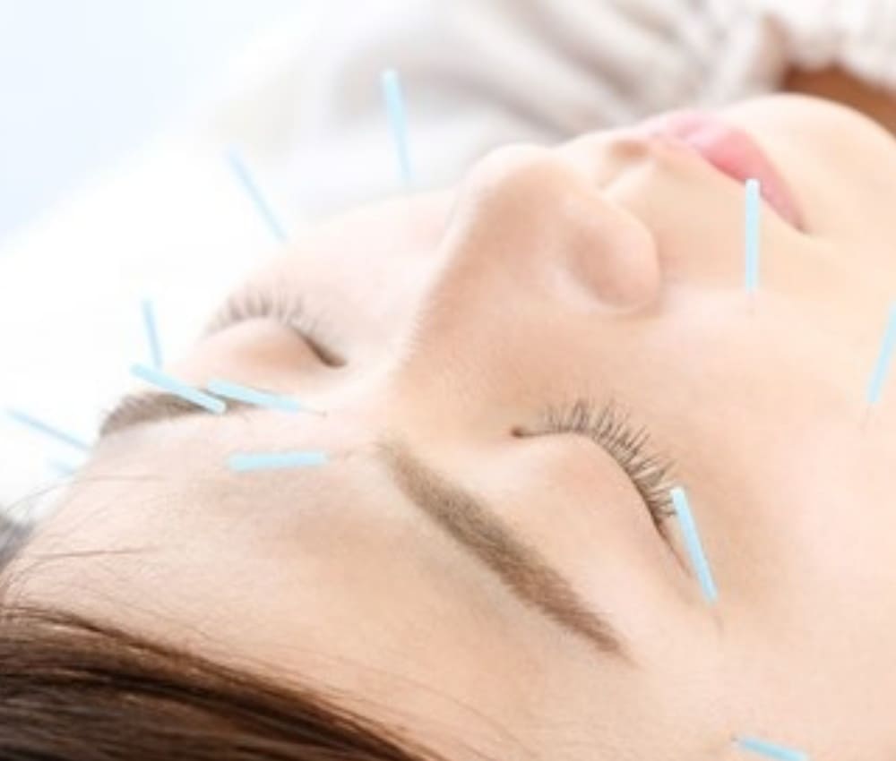 美容鍼